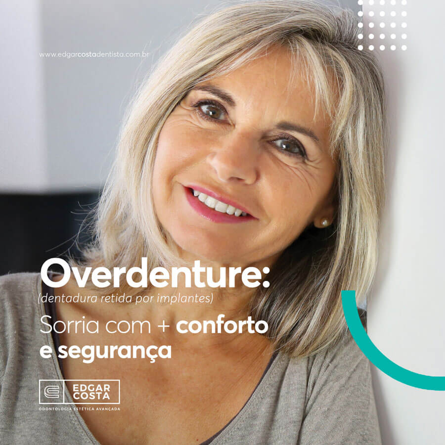 Overdenture - Dentadura retida por implantes