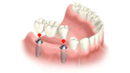 Prótese Parcial Fixa - Edgar Costa Dentista Joinville