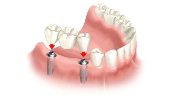 Prótese Parcial Fixa - Edgar Costa Dentista Joinville