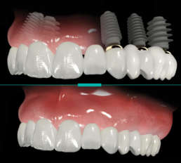 IMPLANTES PARA REABILITAÇÃO TOTAL